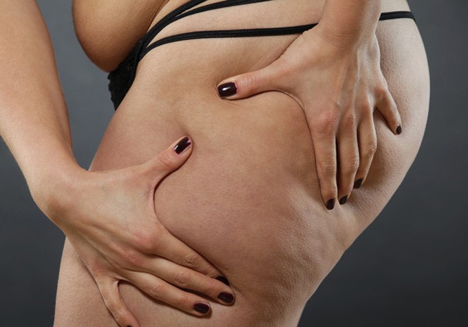 cellulite