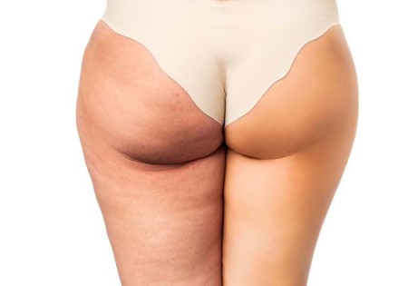 cellulite