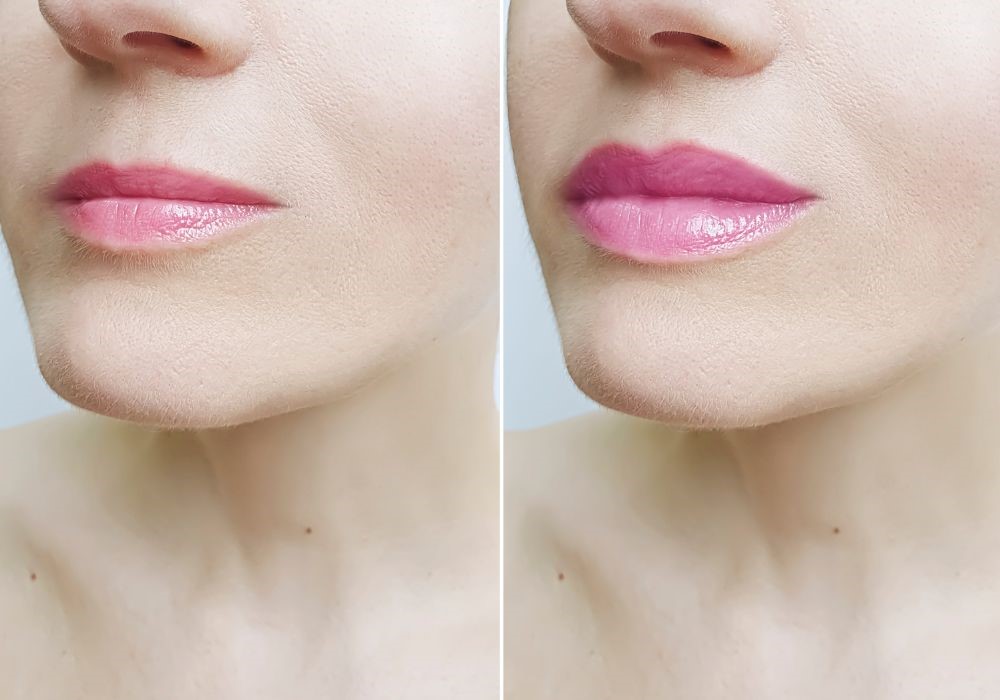 labbra sottili 2